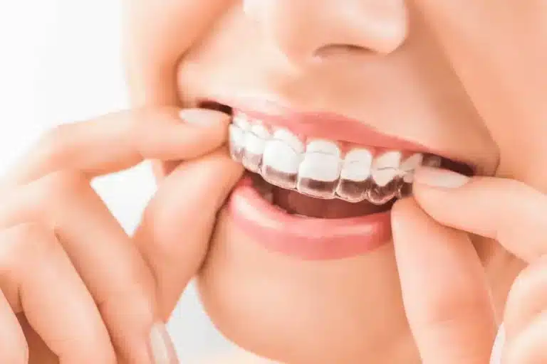 Straighten Your Smile with Expert Orthodontic Solutions