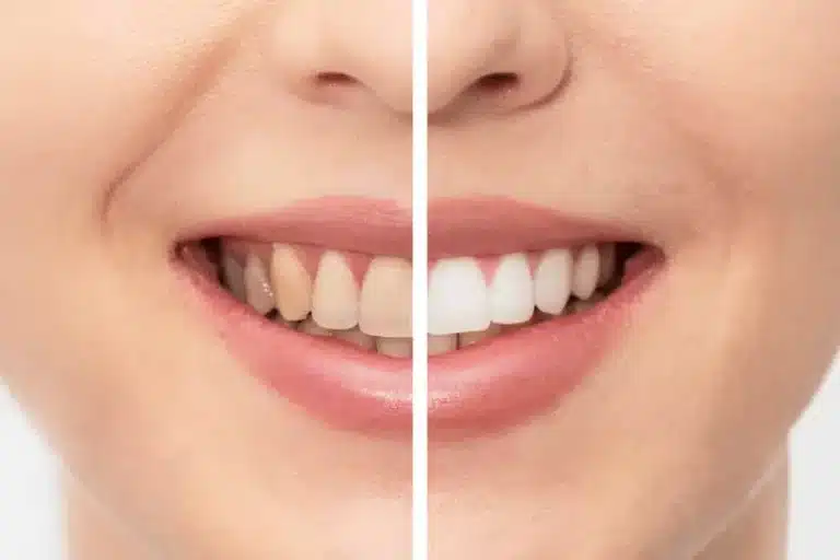 Professional Teeth Whitening: Everything You Need To Know